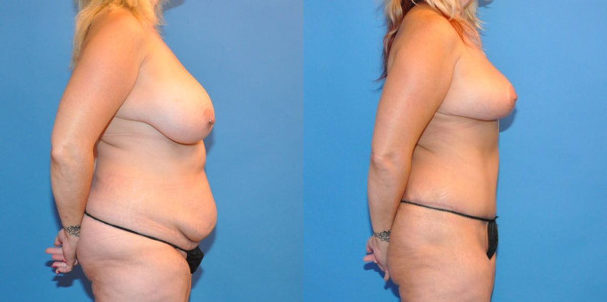 Mommy Makeover #6 - Before and After