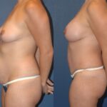 Mommy Makeover #7 - Before and After