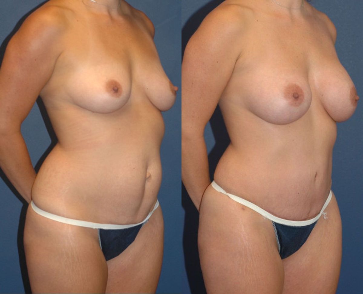 Mommy Makeover #7 - Before and After