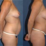 Mommy Makeover #7 - Before and After