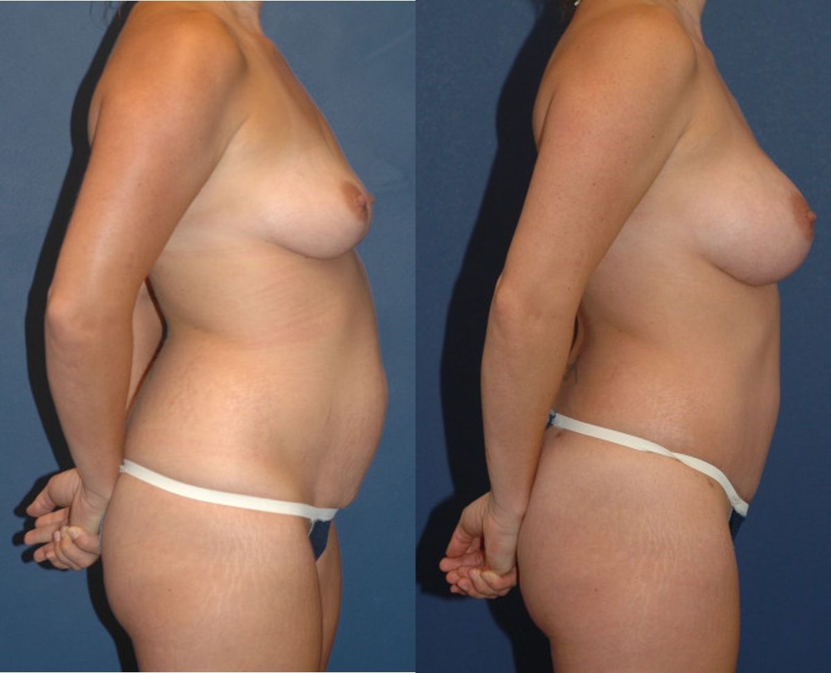 Mommy Makeover #7 - Before and After