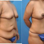 Mommy Makeover #8 - Before and After