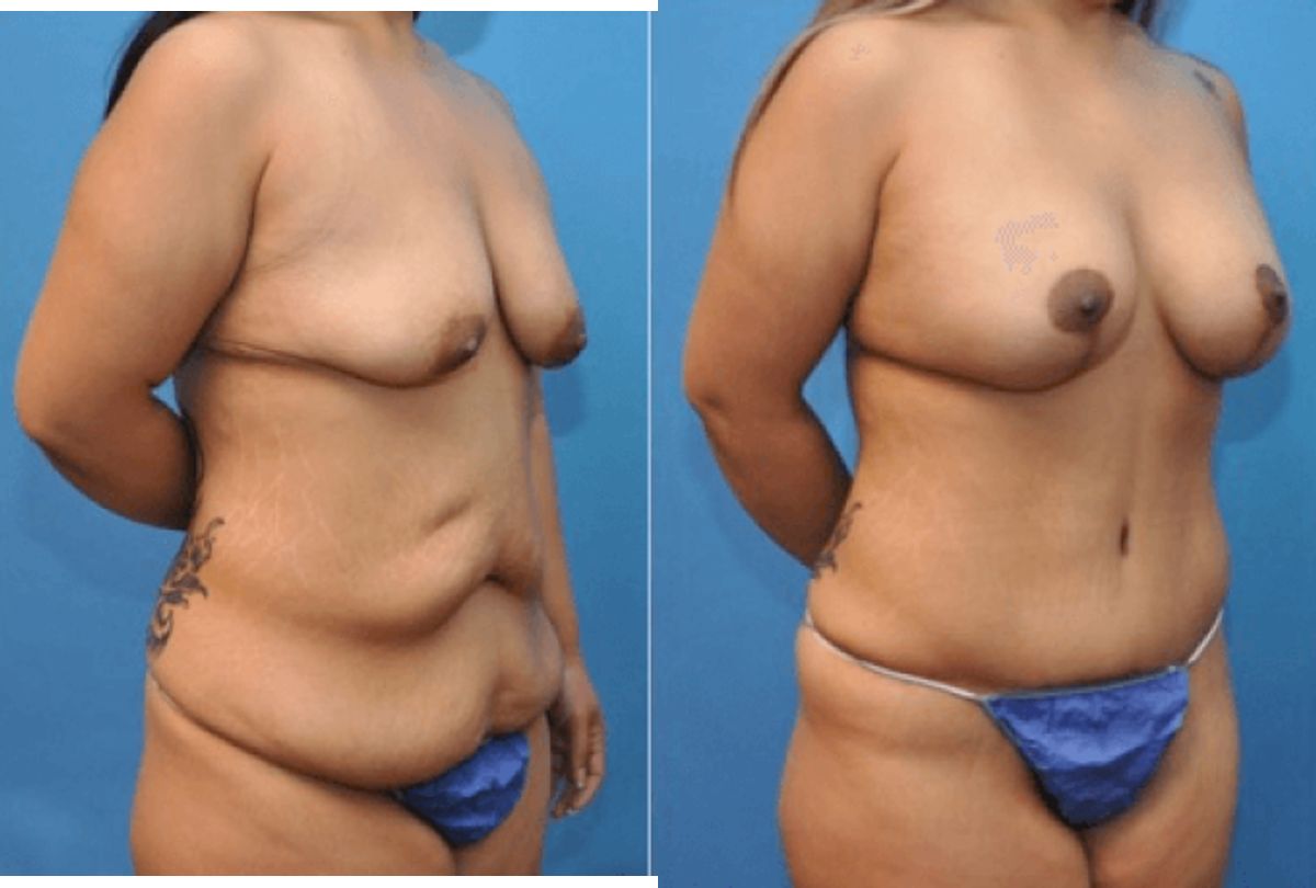 Mommy Makeover #8 - Before and After