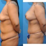 Mommy Makeover #8 - Before and After