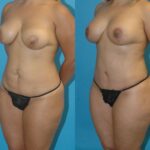 Mommy Makeover #9 - Before and After