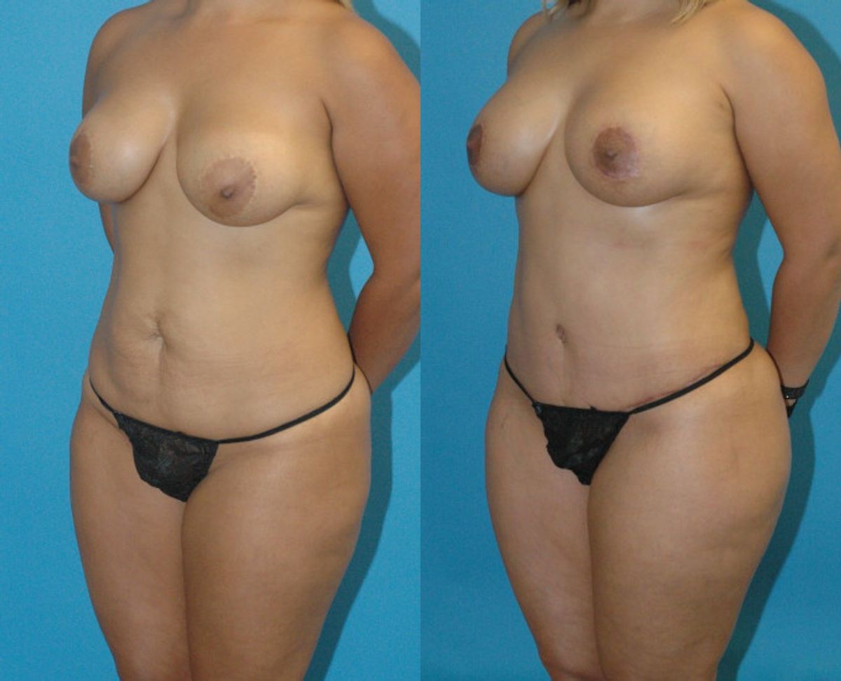 Mommy Makeover #9 - Before and After