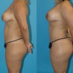 Mommy Makeover #9 - Before and After