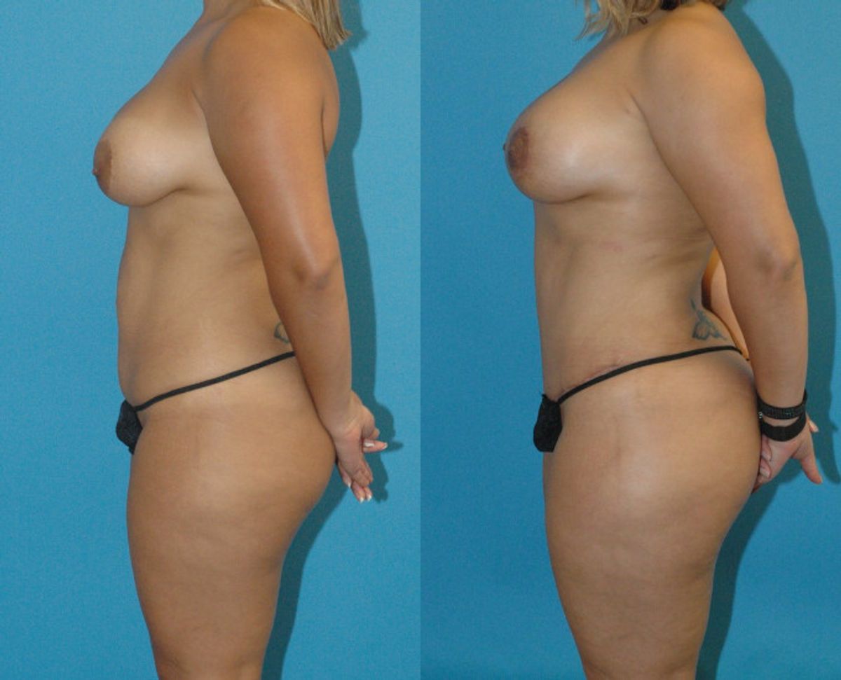 Mommy Makeover #9 - Before and After