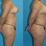 Mommy Makeover #9 - Before and After