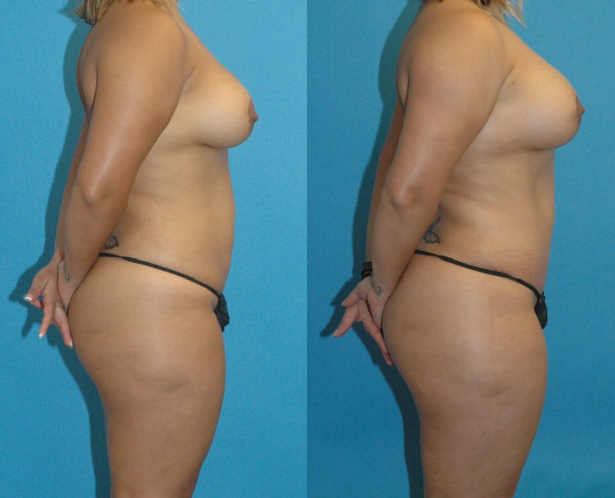 Mommy Makeover #9 - Before and After