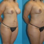 Mommy Makeover #9 - Before and After