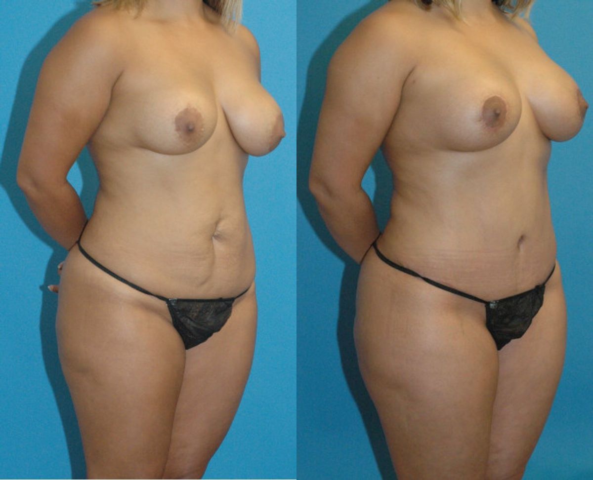 Mommy Makeover #9 - Before and After