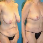 Mommy Makeover #10 - Before and After