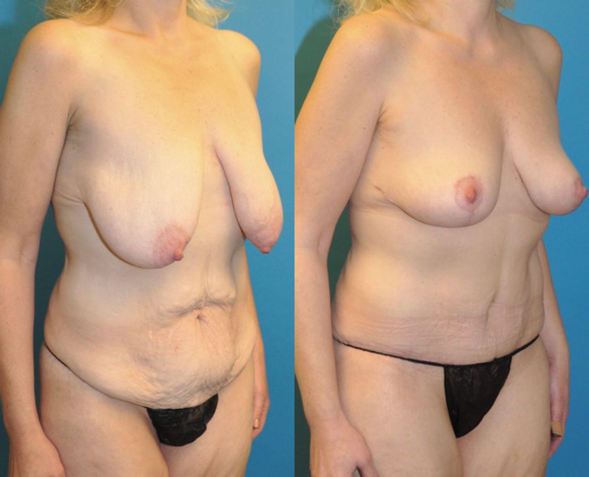 Mommy Makeover #10 - Before and After