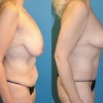 Mommy Makeover #10 - Before and After