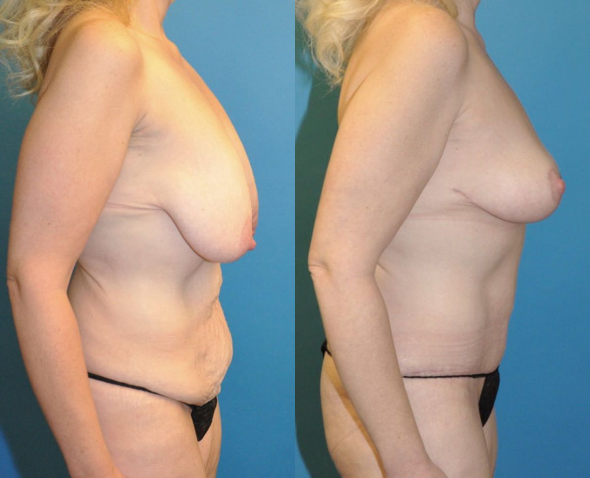 Mommy Makeover #10 - Before and After