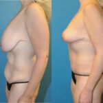 Mommy Makeover #10 - Before and After