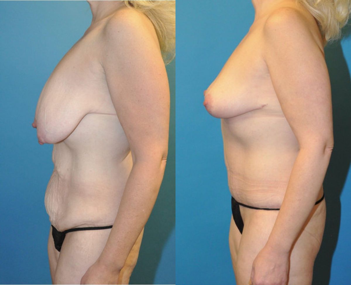 Mommy Makeover #10 - Before and After