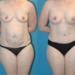 Mommy Makeover #11 - Before and After