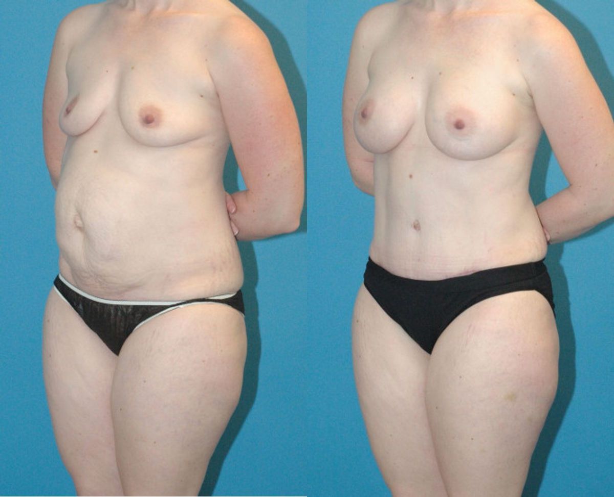 Mommy Makeover #11 - Before and After