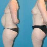 Mommy Makeover #11 - Before and After