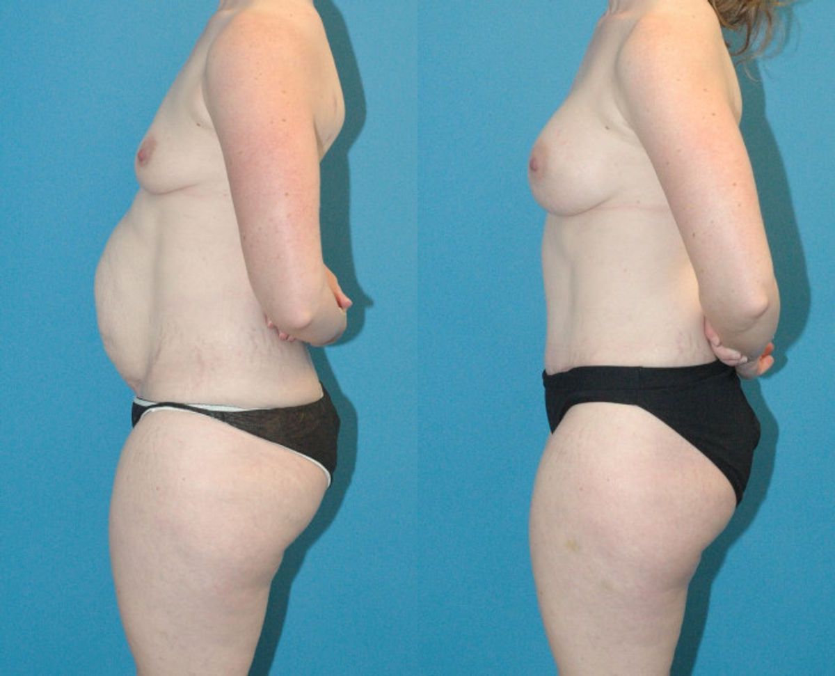 Mommy Makeover #11 - Before and After