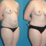 Mommy Makeover #11 - Before and After