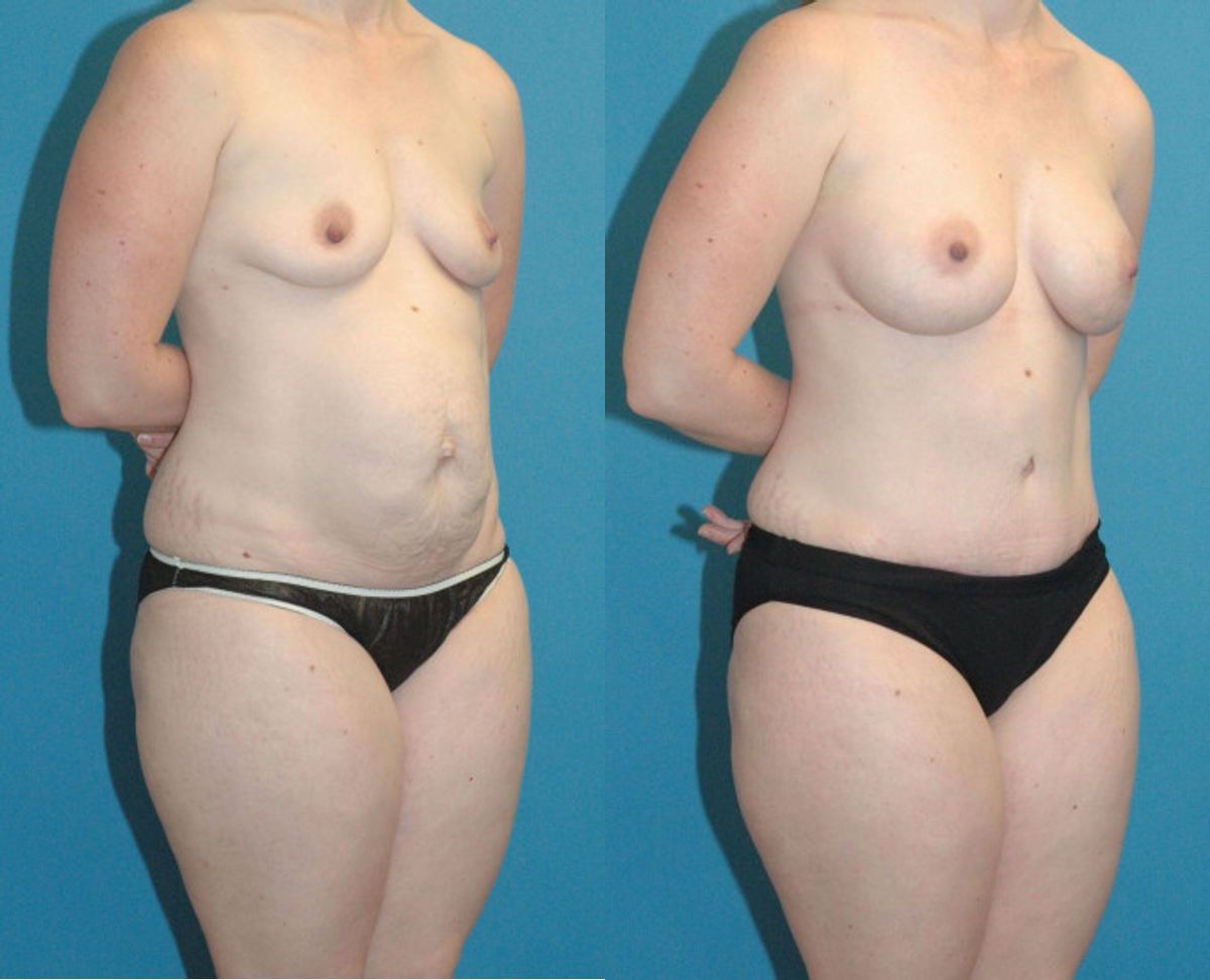 Mommy Makeover #11 - Before and After