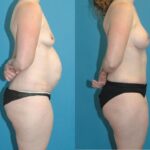 Mommy Makeover #11 - Before and After