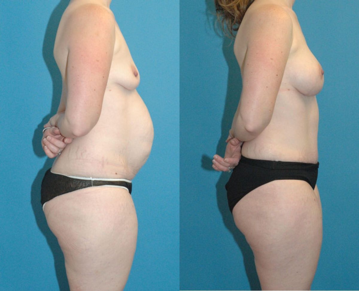 Mommy Makeover #11 - Before and After