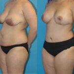 Mommy Makeover #12 - Before and After