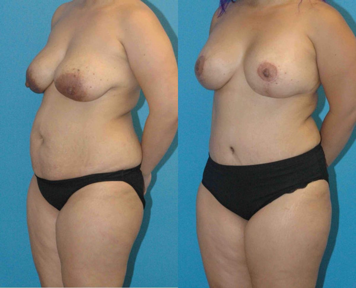 Mommy Makeover #12 - Before and After