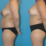 Mommy Makeover #12 - Before and After