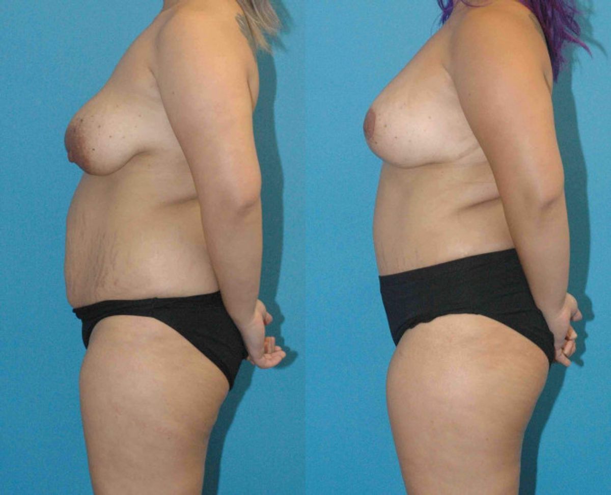 Mommy Makeover #12 - Before and After