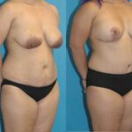 Mommy Makeover #12 - Before and After