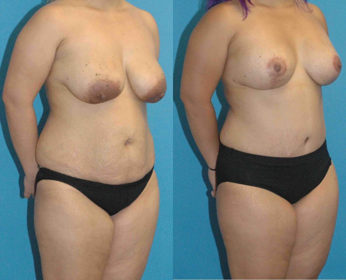 Mommy Makeover #12 - Before and After