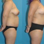 Mommy Makeover #12 - Before and After