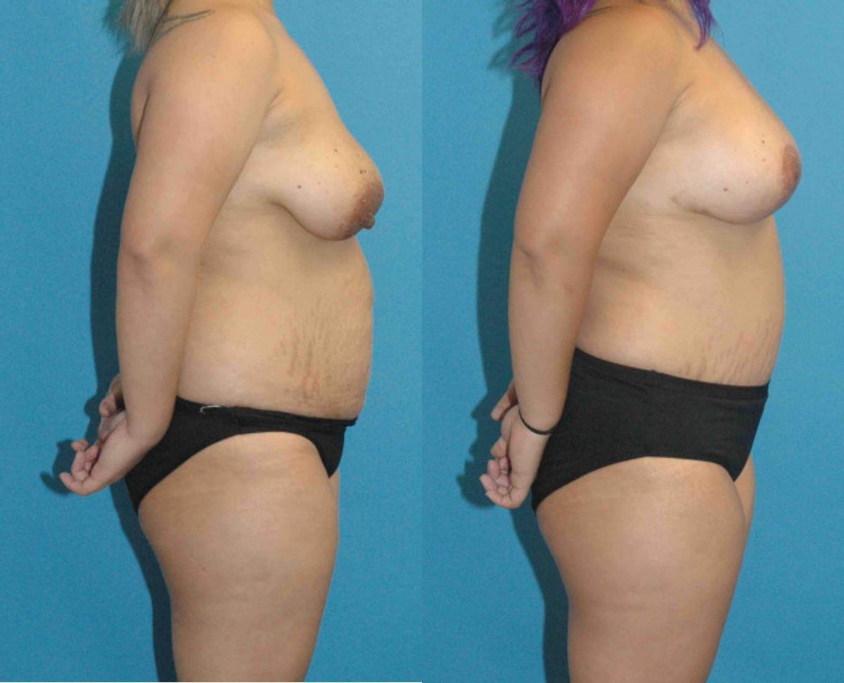 Mommy Makeover #12 - Before and After