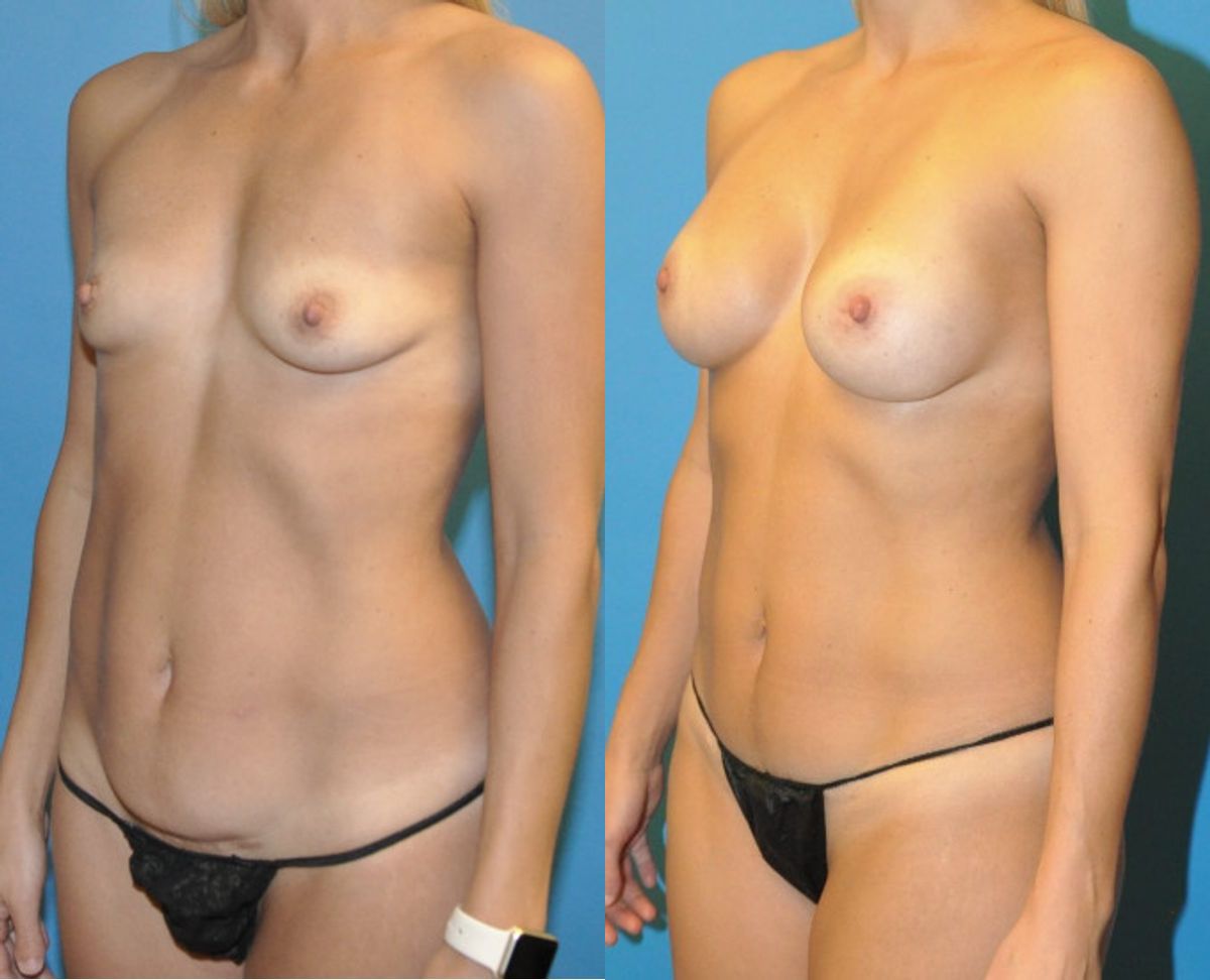 Mommy Makeover #13 - Before and After