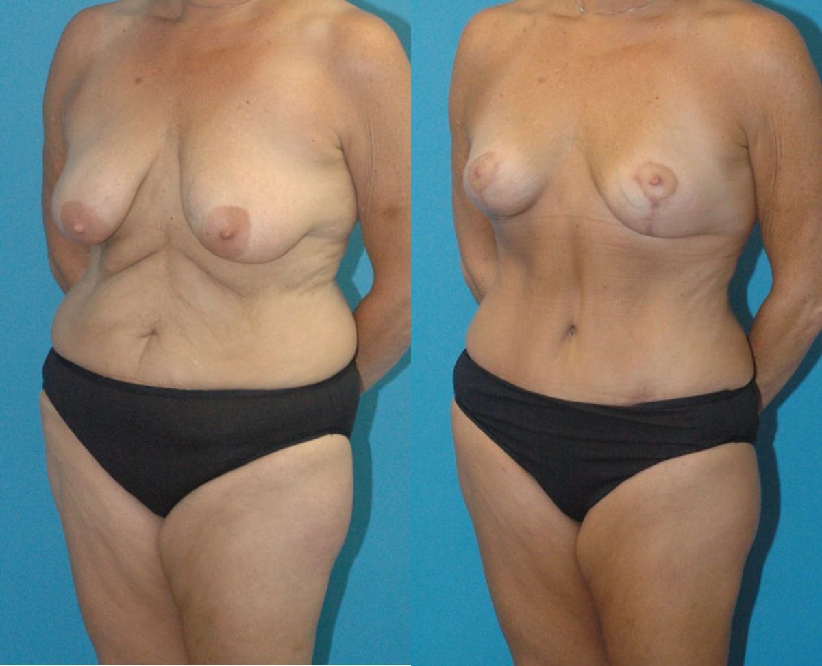 Mommy Makeover #14 - Before and After