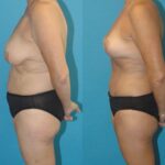 Mommy Makeover #14 - Before and After