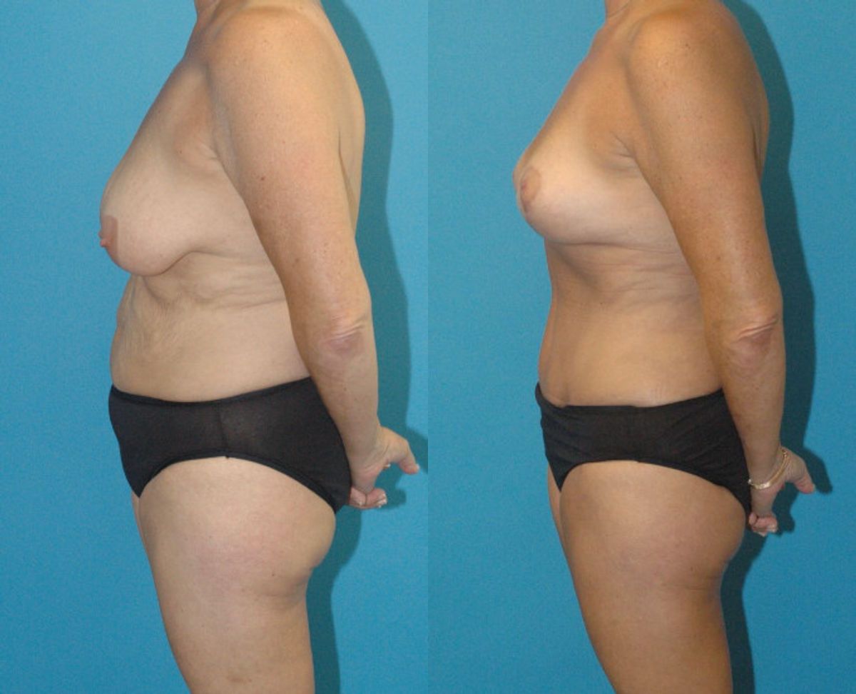 Mommy Makeover #14 - Before and After