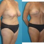 Mommy Makeover #14 - Before and After