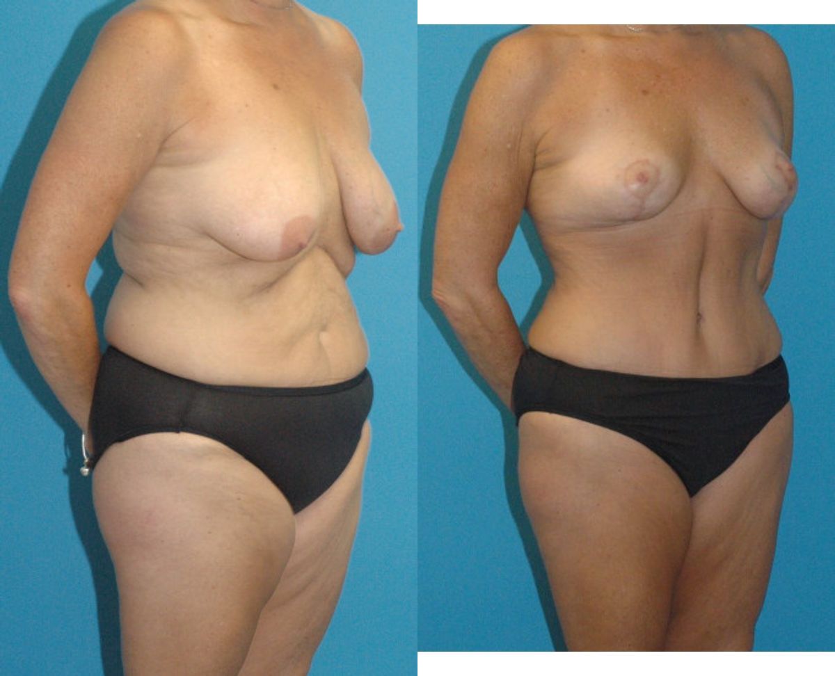 Mommy Makeover #14 - Before and After