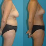 Mommy Makeover #14 - Before and After