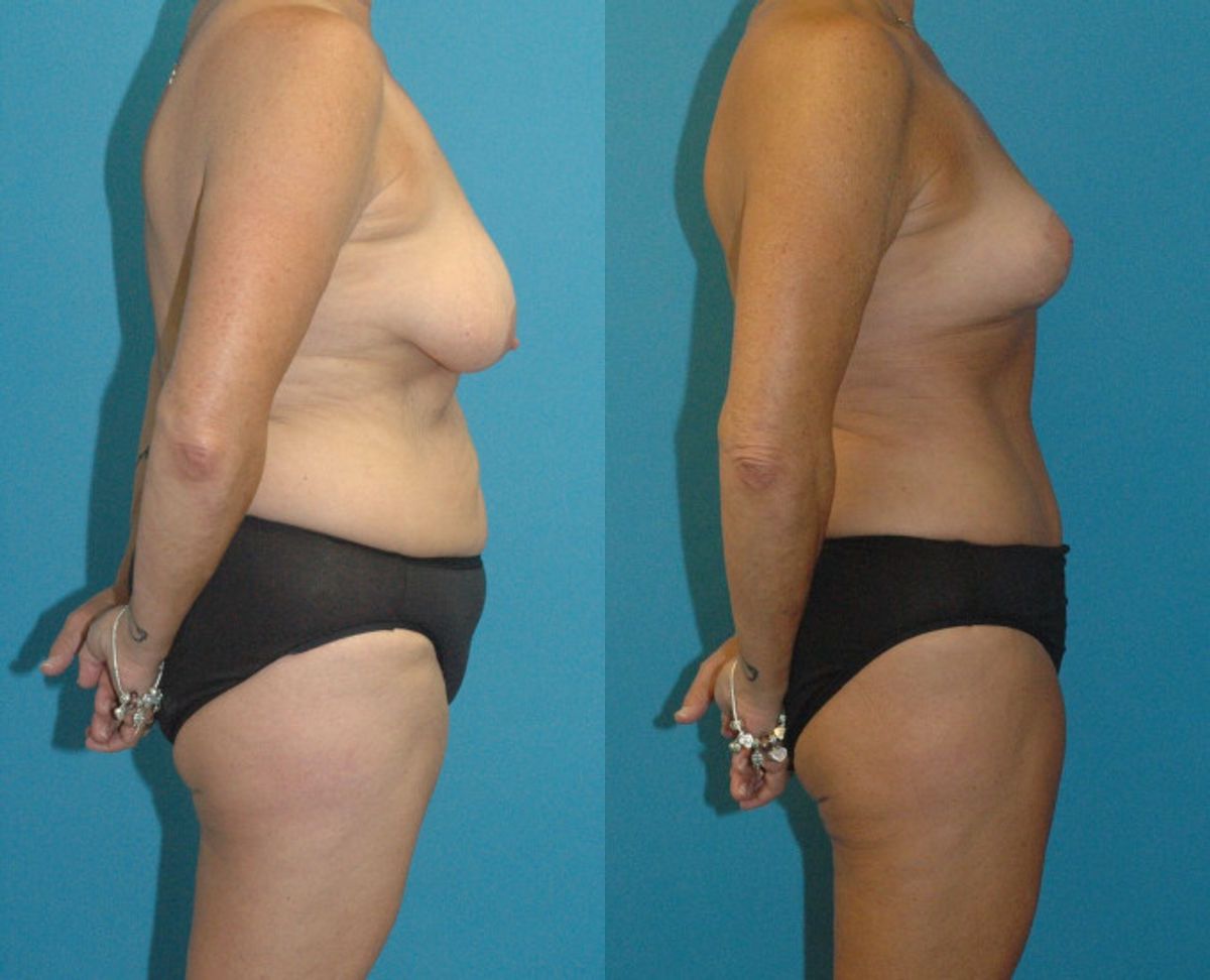 Mommy Makeover #14 - Before and After