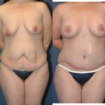 Mommy Makeover #15 - Before and After