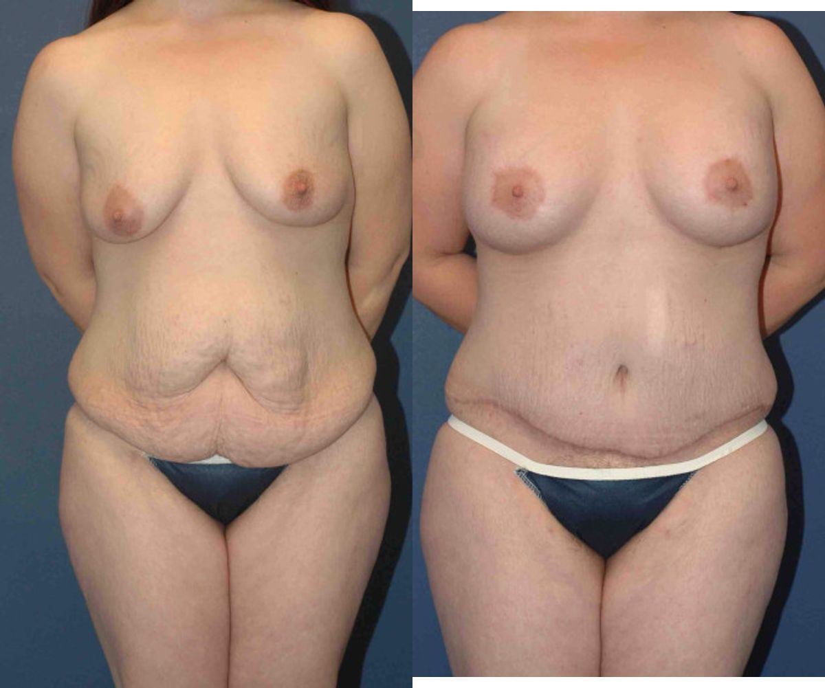 Mommy Makeover #15 - Before and After