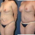 Mommy Makeover #15 - Before and After