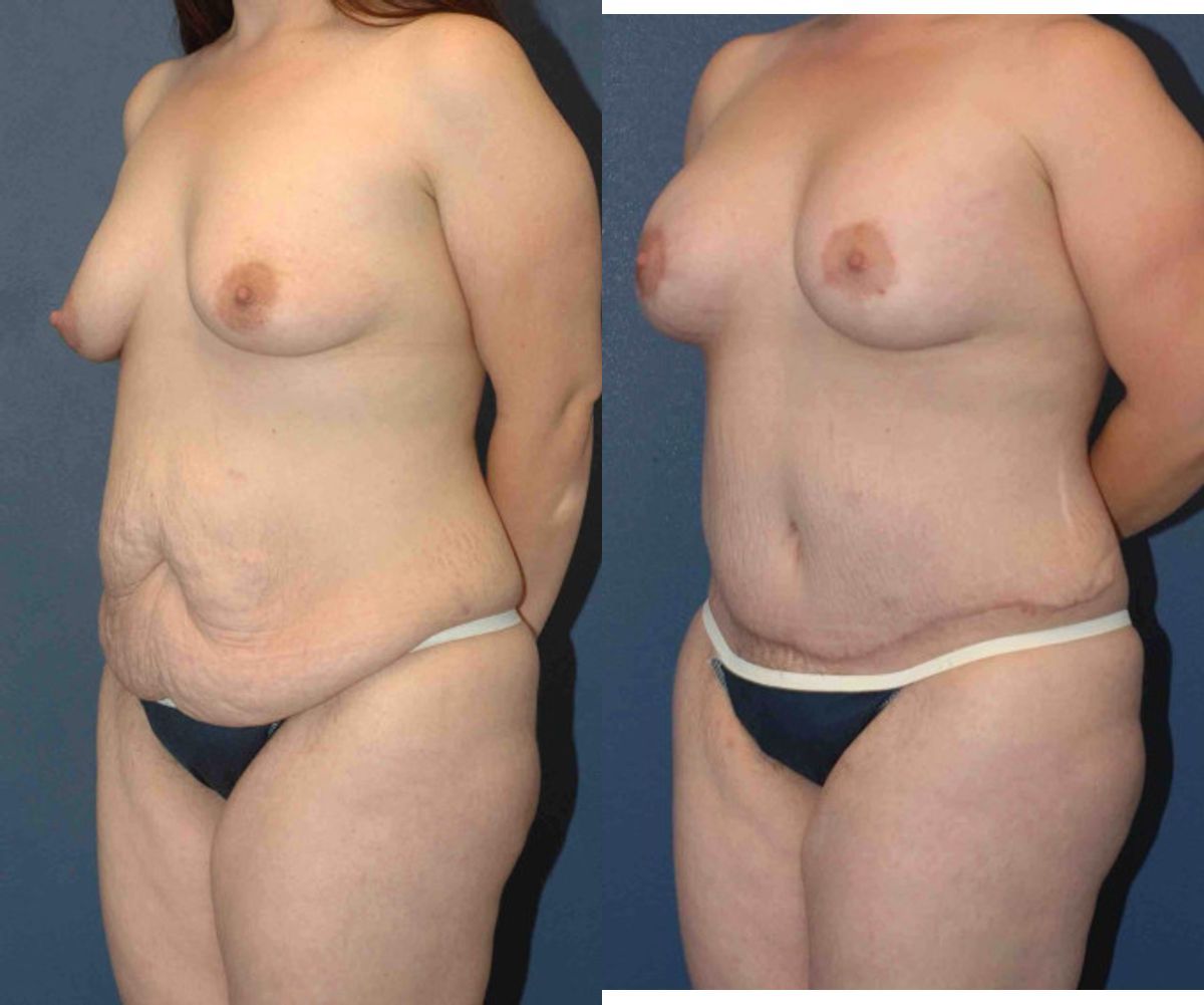 Mommy Makeover #15 - Before and After